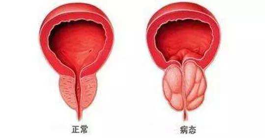 前列腺增生伴钙化